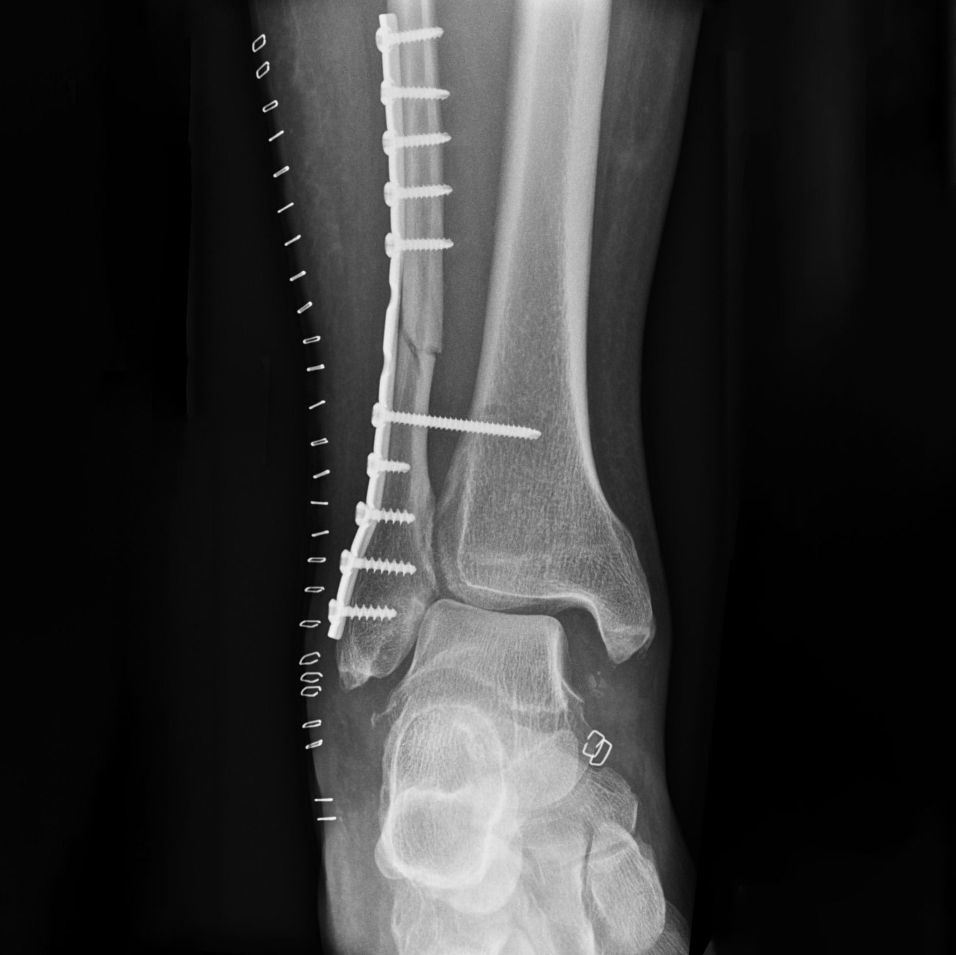 X-ray image taken after operation 2 showing the pins