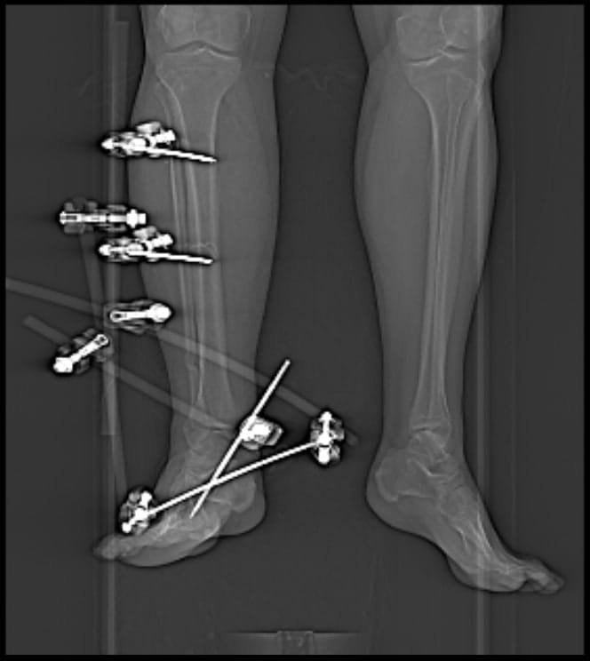 X-ray image showing the external fixator positions