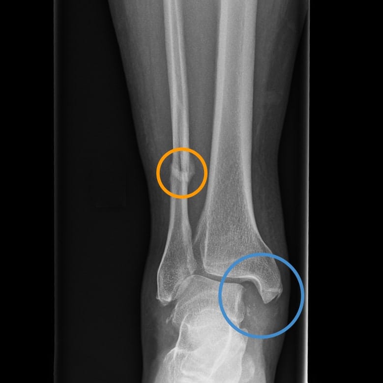 X-Ray image of my lower leg/ankle showing injury